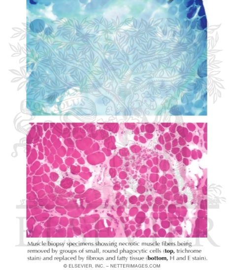 Duchenne Muscular Dystrophy: Muscle Biopsy Specimens