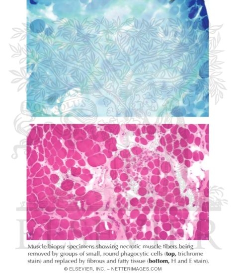 Duchenne Muscular Dystrophy: Muscle Biopsy Specimens