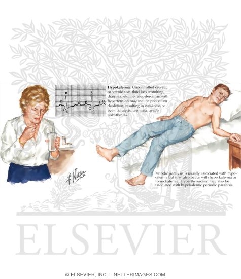 Watermarked preview of labeled image: Hypokalemia Associated Myopathy