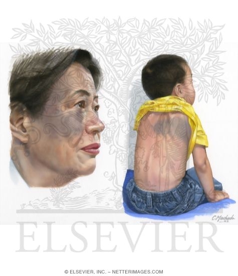 Nevus of Ota and Ito