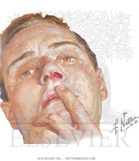 Furuncle of Nasal Mucosa