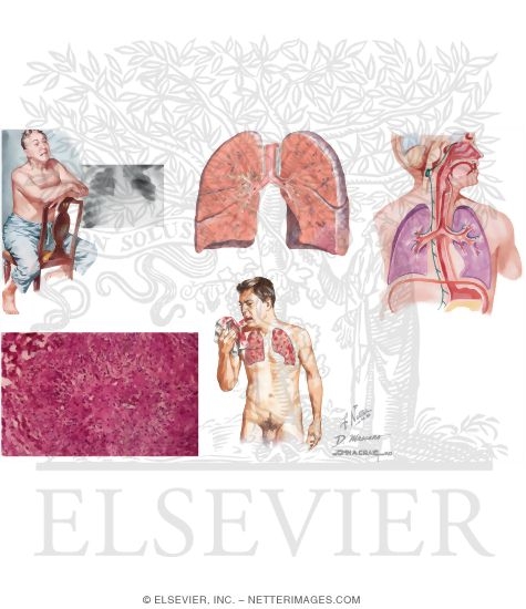 Noninfectious Causes of An Abnormal Chest Radiograph