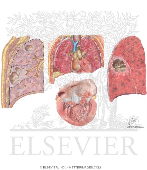 Watermarked preview of unlabeled image: Complications of Hospital-Acquired Pneumonia