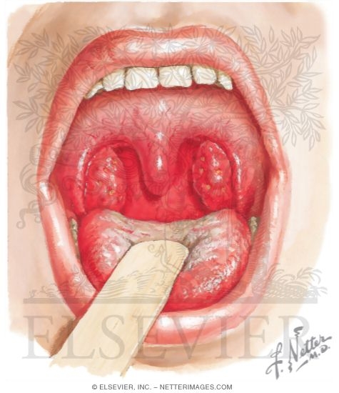 Streptococcal Pharyngitis