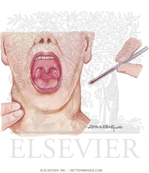 Epstein-Barr Virus Pharyngitis