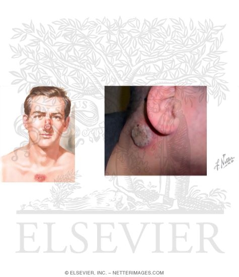 Watermarked preview of unlabeled image: Skin Lesions In Blastomycosis