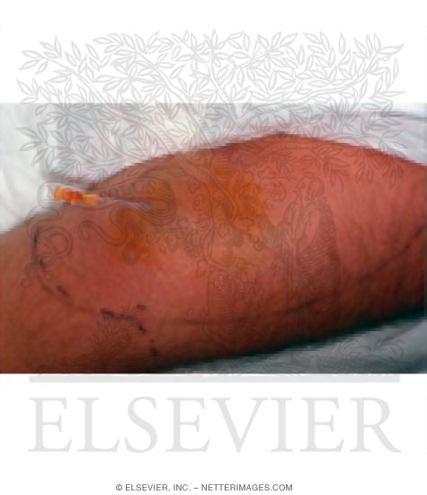 Purulent Cellulitis