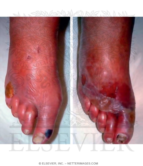 Staphylococcal Scalded Skin Syndrome