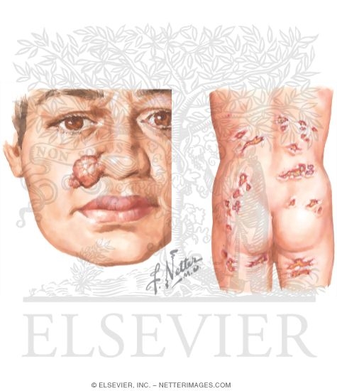 Watermarked preview of unlabeled image: Skin Lesions In Coccidioidomycosis