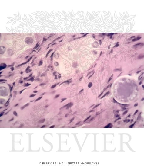 Watermarked preview of unlabeled image: Coccidioides