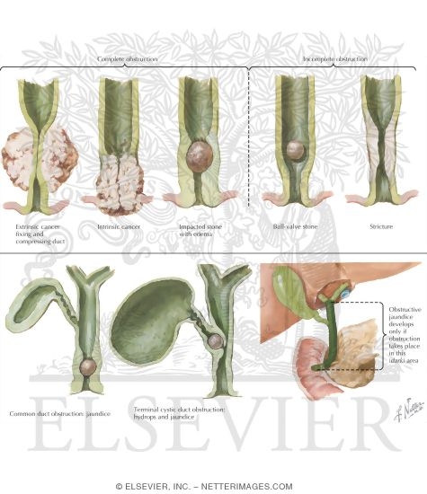 Mechanisms of Biliary Obstruction