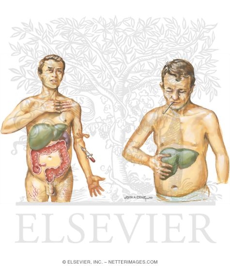Clinical Manifestations of Acute Cholangitis