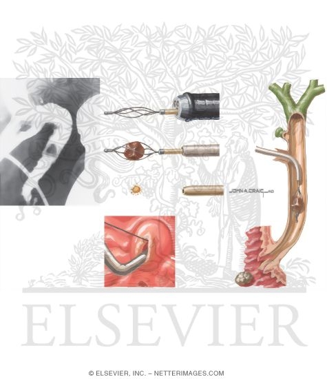 Watermarked preview of unlabeled image: Operative Biliary Decompression