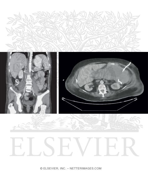 Abscess Drainage