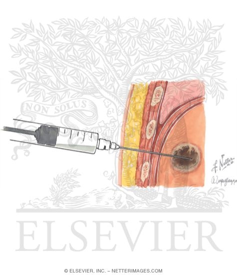 Percutaneous Drainage of Liver Abscess