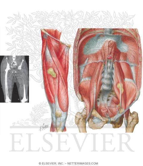 Watermarked preview of unlabeled image: Possible Anatomic Locations of Abscesses In Pyomyositis