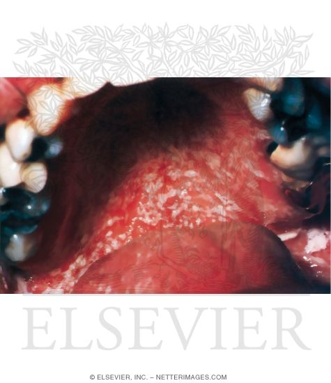 Oral Candidiasis
