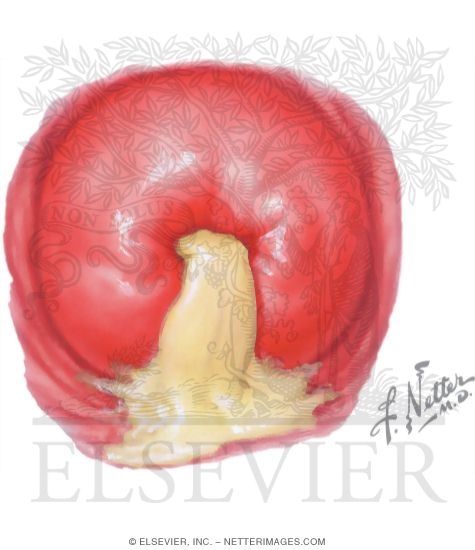 Mucopurulent Cervicitis
