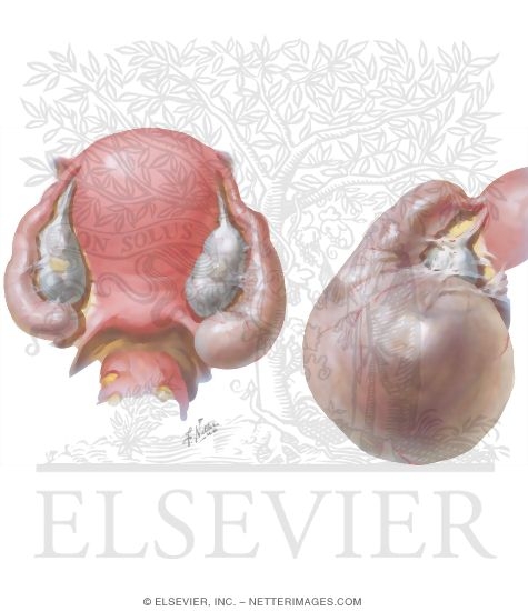 Pelvic Inflammatory Disease