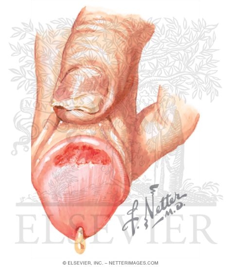 Urethritis