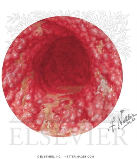 Watermarked preview of unlabeled image: Proctocolitis