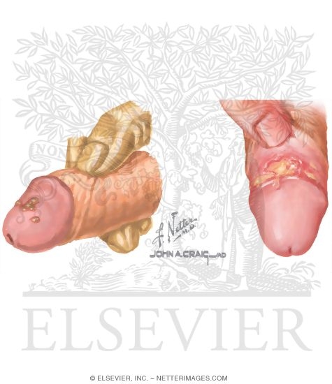 Genital Ulcers: Herpes and Chancroid