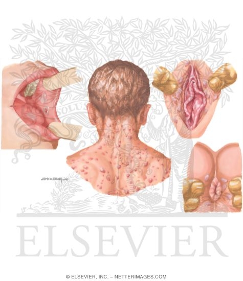 Secondary Syphilis: Mucocutaneous Manifestations