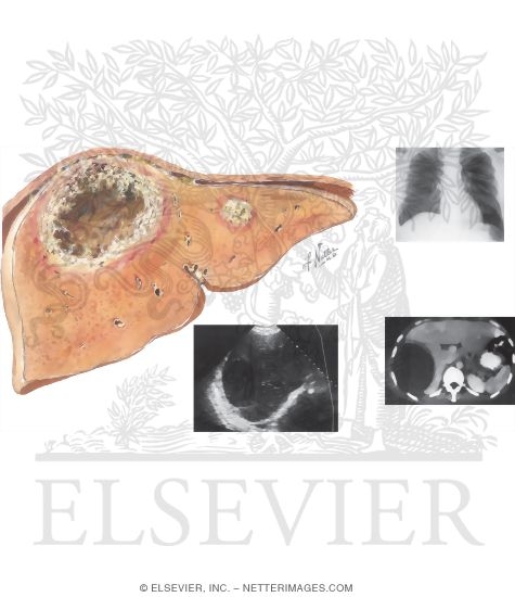 Amebic Liver Abscess