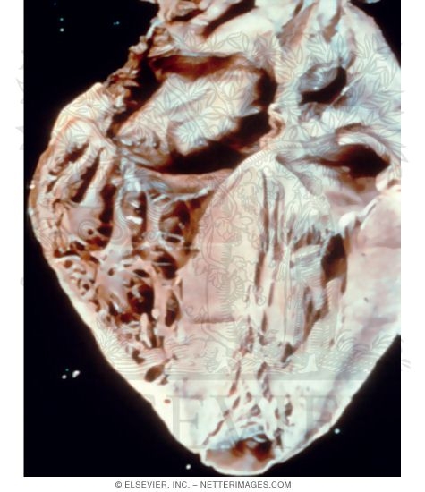 Watermarked preview of unlabeled image: Autopsy Specimen of a Heart That Is Dilated and Hypertrophied