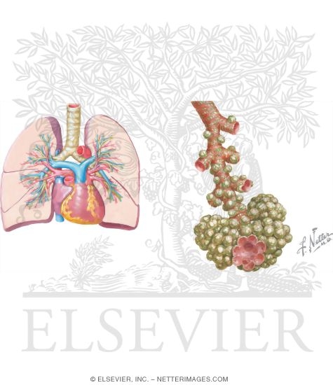 Mechanism of Acute Respiratory Distress Syndrome