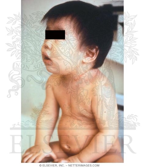 Child With Rubella Rash