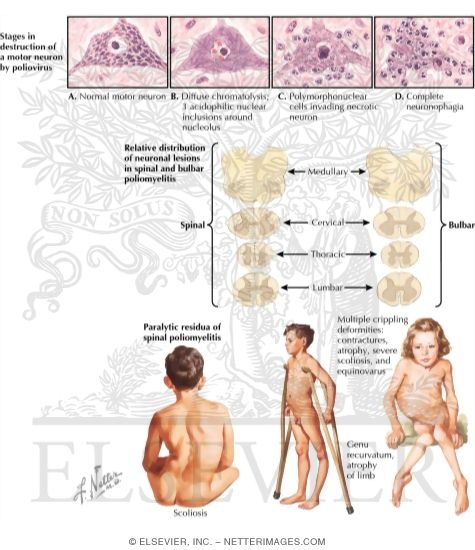 Poliomyelitis