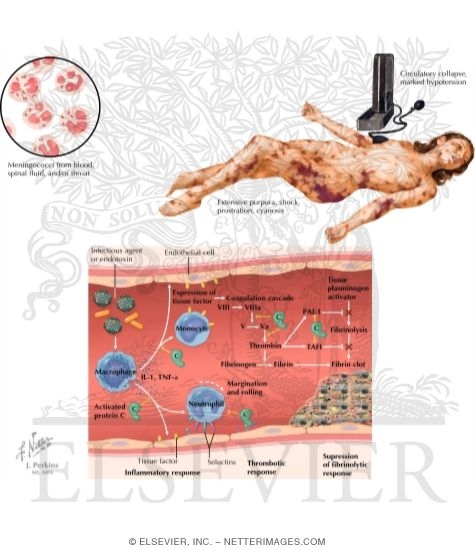 Disseminated Intravascular Coagulation (DIC)