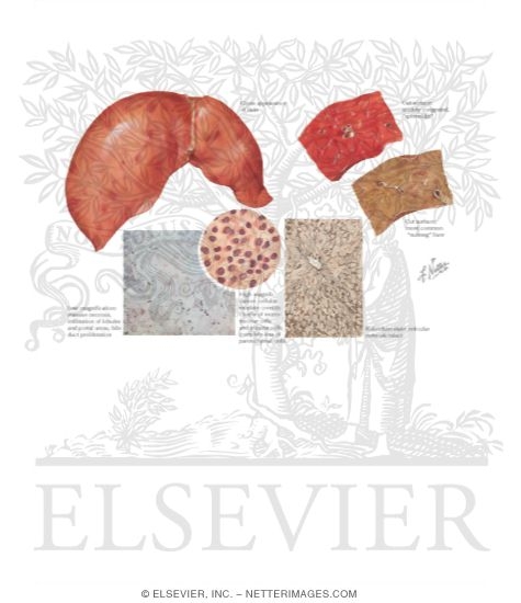 Watermarked preview of labeled image: Viral Hepatitis: Fulminant Form (Acute Massive Necrosis)