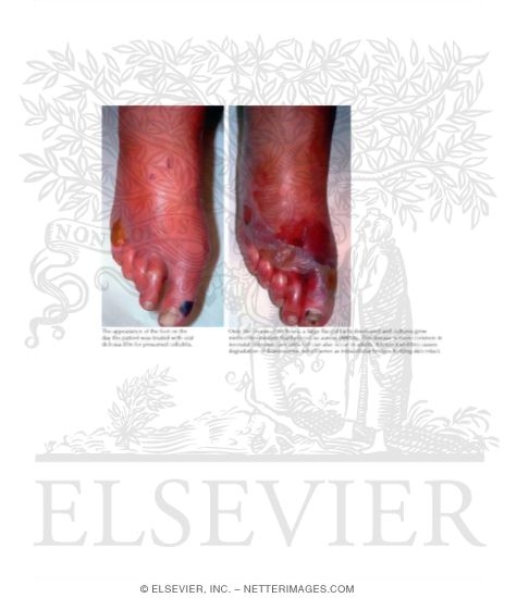 Staphylococcal Scalded Skin Syndrome