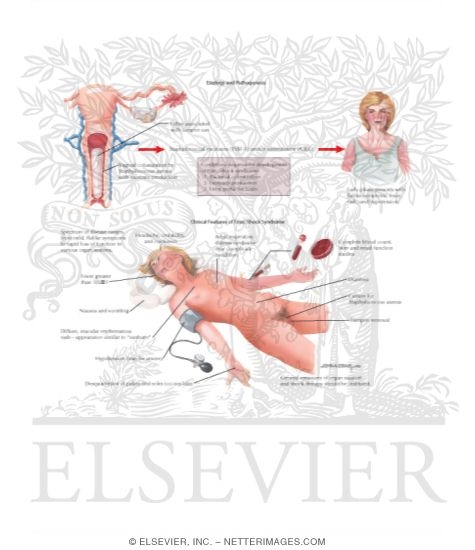 Watermarked preview of labeled image: Toxic Shock Syndrome