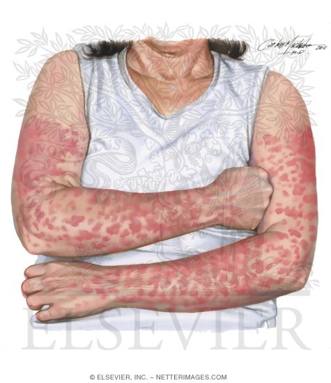 Solar Urticaria