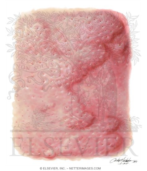 Watermarked preview of unlabeled image: Urticaria Edematous Plaques: Folicular Accentuation