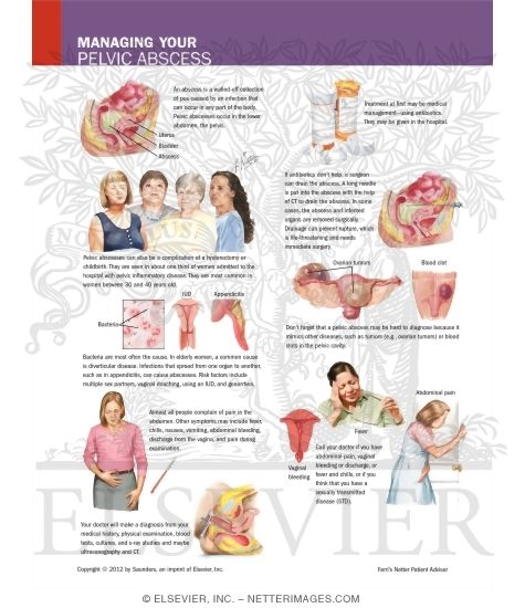 Managing Your Pelvic Abscesses
