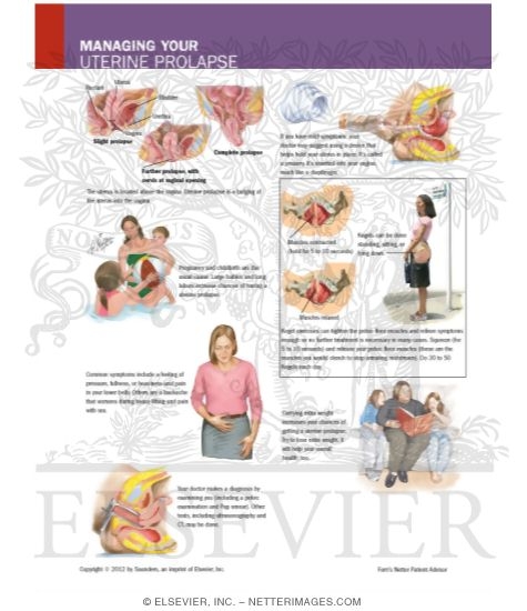 Watermarked preview of labeled image: Managing Your Uterine Prolapse