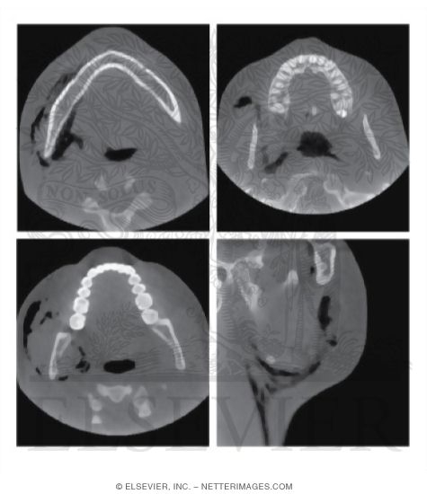Cervical Emphysema