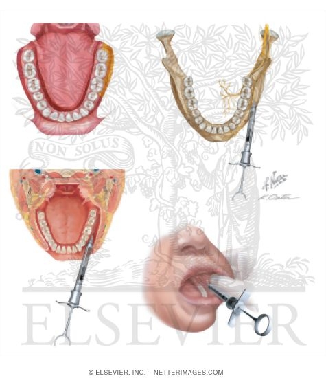Long Buccal Nerve Block