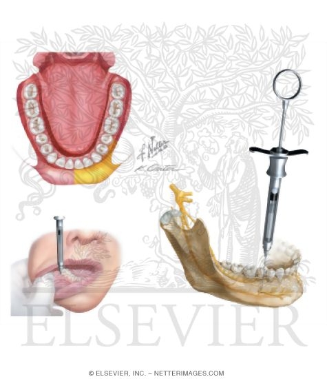 Mental Nerve Block