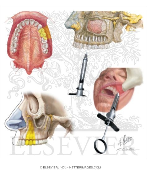 Maxillary Injections: Middle Superior Alveolar Nerve Block