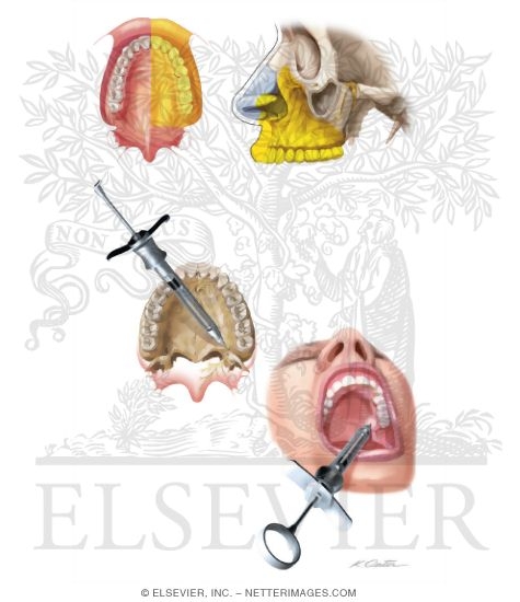 Watermarked preview of unlabeled image: Maxillary Injections: Maxillary Division Block