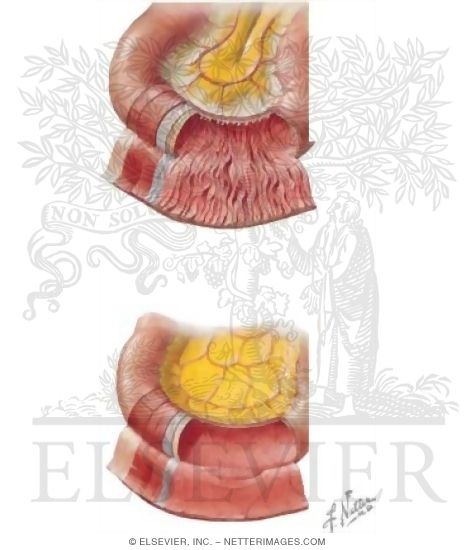 Watermarked preview of unlabeled image: Contents of the Abdomen: Jejunum and Ileum