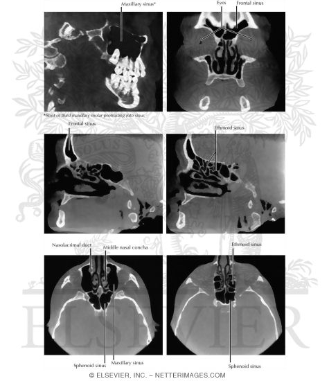 Functional Endoscopic Sinus Surgery