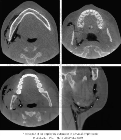 Cervical Emphysema