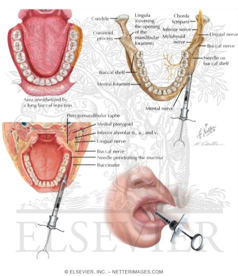 Long Buccal Nerve Block
