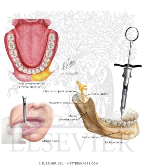 Mental Nerve Block